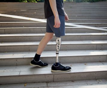 Young man with prosthetic leg walking
